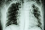 Pulmonary Tuberculosis .  Chest X-ray : Interstitial Infiltratio Stock Photo