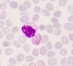Blood Films For Malaria Parasite Stock Photo