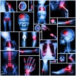 Collection Of X-ray Multiple Part Of Human,orthopedic Operation And Multiple Disease (shoulder Dislocation,stroke,fracture,gout,rheumatoid Arthritis,bronchiectasis,osteoarthritis Knee, Etc ) Stock Photo