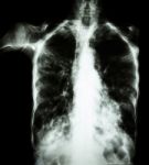 Pulmonary Tuberculosis  ( Film Chest X-ray :  Interstitial Infiltrate Both Lung Due To Mycobacterium Tuberculosis Infection ) Stock Photo