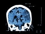 Cerebral Infarction At Left Hemisphere ( Ischemic Stroke ) ( Ct-scan Of Brain ) : Medicine And Science Background Stock Photo