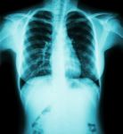 Film Chest X-ray : Show Normal Chest Of Woman Stock Photo