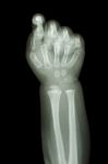 Normal Infant's Hand Bone Stock Photo