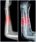 Fracture Shaft Of Ulnar Bone ( Forearm Bone )  : ( Left : Pre-treatment  ,  Right : Psot-treatment (splint With Cast) ) Stock Photo