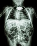X-ray Body Of Child And Tracheostomy Tube Stock Photo