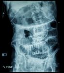 Small Bowel Obstruction ( Film X-ray Abdomen ( Supine Position ) : Show Small Bowel And Stomach Dilate ) ( Step Ladder Pattern ) Stock Photo