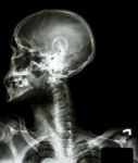 X-ray Asian Skull(thai People),cervical Spine,both Shoulder And Stock Photo