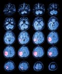Mri Brain : Brain Tumor At Right Parietal Lobe Stock Photo