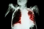 Pulmonary Tuberculosis With Acute Respiratory Failure ( Film Chest X-ray Of Old Patient Show Alveolar And Interstitial Infiltration Both Lung With Endotracheal Tube ) Due To Mycobacterium Tuberculosis Stock Photo