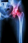 Arthritis At Hip Joint ( X-ray Pelvis & Hip Joint ) , ( Gout , Rheumatoid ) Stock Photo