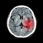 Ct Scan Of Brain Show Ischemic Stroke Or Hemorrhagic Stroke Stock Photo