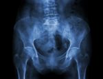 Film X-ray Pelvis Of Osteoporosis Patient Stock Photo