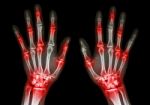 Film X-ray Both Human's Hands And Arthritis At Multiple Joint (gout,rheumatoid) Stock Photo