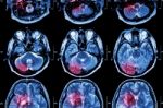 Film Mri ( Magnetic Resonance Imaging ) Of Brain ( Stroke , Brain Tumor , Cerebral Infarction , Intracerebral Hemorrhage )  ( Medical , Health Care , Science Background ) ( Cross Section Of Brain ) Stock Photo