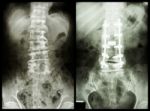 "spondylosis" (left Image) , Patient Was Operated And Internal Fixed. (right Image) Stock Photo