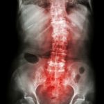 Spondylosis And Scoliosis ( Film X-ray Lumbar - Sacrum Spine Show Crooked Spine ) ( Old Patient ) ( Spine Healthcare ) Stock Photo