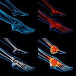 3d Rendering Human Foot Pain With The Anatomy Of A Skeleton Foot Stock Photo