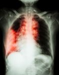 Lung Cancer .  Film Chest X-ray Show Right Lung Mass , Wide Mediastinum , Pneumonia And Right Pleural Effusion Stock Photo