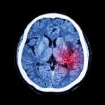 Ct Scan Of Brain Show Ischemic Stroke Or Hemorrhagic Stroke Stock Photo