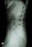 X-ray Lumbo-sacral Spine (lateral) Of Asian Adult People Stock Photo