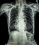 Chest X-ray Of Old Patient ( Calcification At Rib , Trachea , Bronchus ) Stock Photo