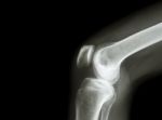 Film X-ray Knee Joint With Arthritis ( Gout , Rheumatoid Arthritis , Septic Arthritis , Osteoarthritis Knee ) And Blank Area At Left Side Stock Photo
