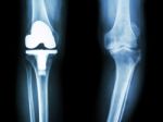 Film X-ray Knee Of Osteoarthritis Knee Patient And Artificial Joint Stock Photo