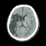 Ct Brain : Show Ischemic Stroke (hypodensity At Right Frontal-pa Stock Photo
