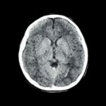 Normal Ct Scan Of Brain (computed Tomography) Stock Photo