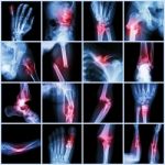 Collection X-ray Multiple Bone Fracture (finger,spine,wrist,hip,leg,clavicle,ankle,elbow,arm,foot) Stock Photo