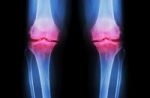 Osteoarthritis Knee ( Oa Knee ). Film X-ray Both Knee ( Front View ) Show Narrow Joint Space ( Joint Cartilage Loss ) , Osteophyte , Subchondral Sclerosis Stock Photo