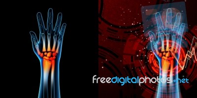 3d Rendered Anatomy Illustration - Hand Pain Stock Image