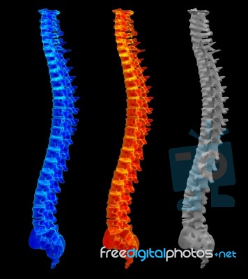 3d Rendering Painful Spine Stock Image