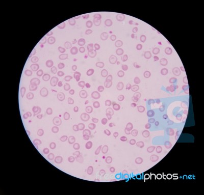 Abnormal Red Blood Cells Science Background Stock Photo