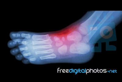 Arthritis And Injury At Ankle  :  Film X-ray Of Child 's Foot ( Side View ) ( Lateral ) Stock Photo