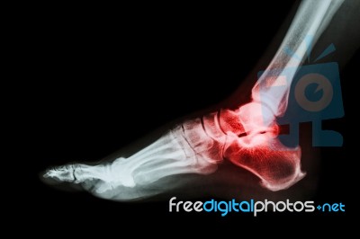 Arthritis At Ankle Joint (gout , Rheumatoid Arthritis) Stock Photo