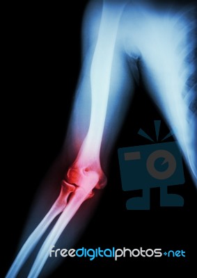 Arthritis At Elbow .  Film X-ray Of Arm , Elbow , Forearm And Inflammation At Elbow ( Gouty Arthritis , Rheumatoid Arthritis )  ( Black Background ) Stock Photo