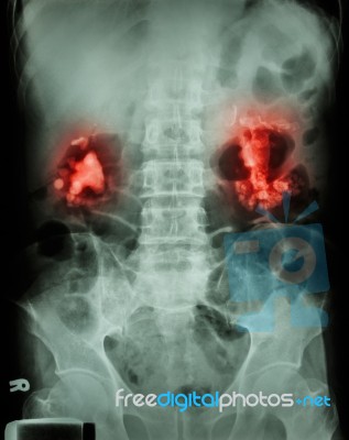 Bilateral Renal Calculi(staghorn) Stock Photo