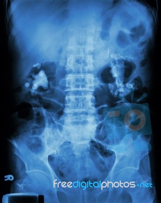 Bilateral Renal Calculi(staghorn) Stock Photo