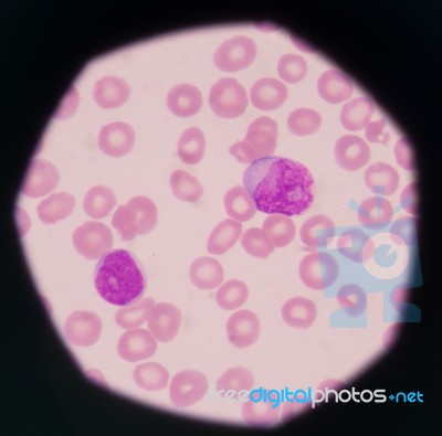 Blast Cells In Peripheral Blood Images Stock Photo