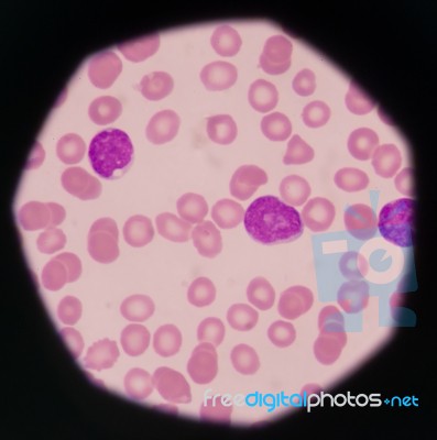 Blast Cells In Peripheral Blood Images Stock Photo