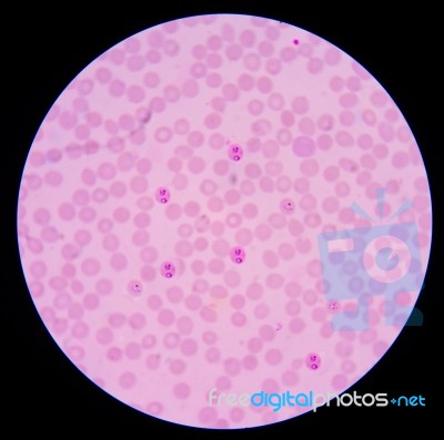 Blood Films For Malaria Parasite.showing Pink Cells Malaria Pigm… Stock Photo