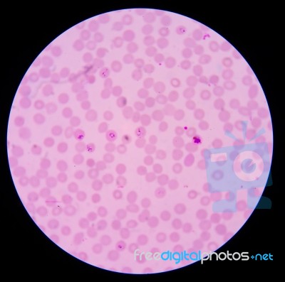 Blood Films For Malaria Parasite.showing Pink Cells Malaria Pigm… Stock Photo