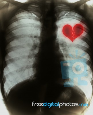 Broken Heart On Black X-ray Film Stock Photo