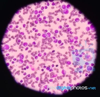 Cancer Cell In Human Showing Abnormal Cells Stock Photo