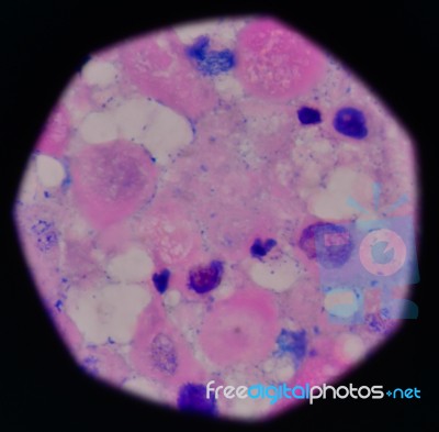 Cell In Human Showing Abnormal Cells Stock Photo