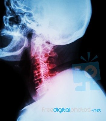 Cervical Spondylosis .  Film X-ray Of Cervical Spine ( Lateral Position ) ( Side View ) Stock Photo