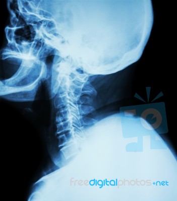 Cervical Spondylosis . Film X-ray Of Cervical Spine ( Lateral Position ) ( Side View ) Stock Photo Cervical Spondylosis . Film X-ray Of Cervical Spine ( Lateral Position ) ( Side View ) Stock Photo
