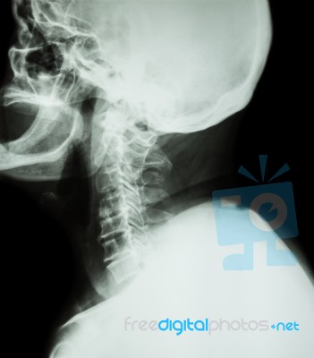 Cervical Spondylosis .  Film X-ray Of Cervical Spine ( Lateral Position ) ( Side View ) Stock Photo