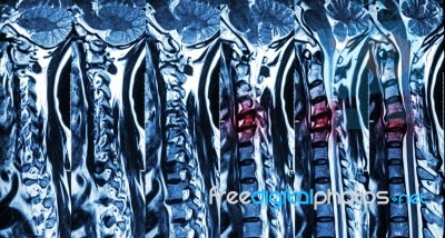 Cervical Spondylosis With Disc Herniation ( Mri Of Cervical Spine : Show Cervical Spondylosis With Disc Herniation Compress Spinal Cord ( Myelopathy ) ) Stock Photo Cervical Spondylosis With Disc Herniation ( Mri Of Cervical Spine : Show Cervical Spondylosis With Disc Herniation Compress Spinal Cord ( Myelopathy ) ) Stock Photo